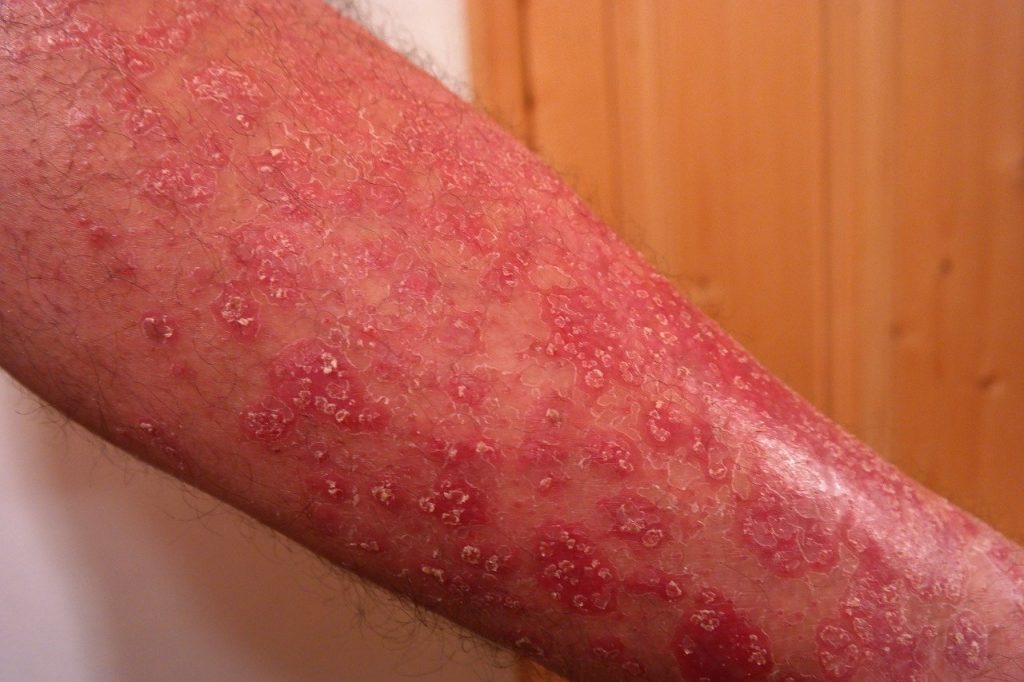 lupénka (psoriasis vulgaris)