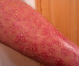 lupénka (psoriasis vulgaris)